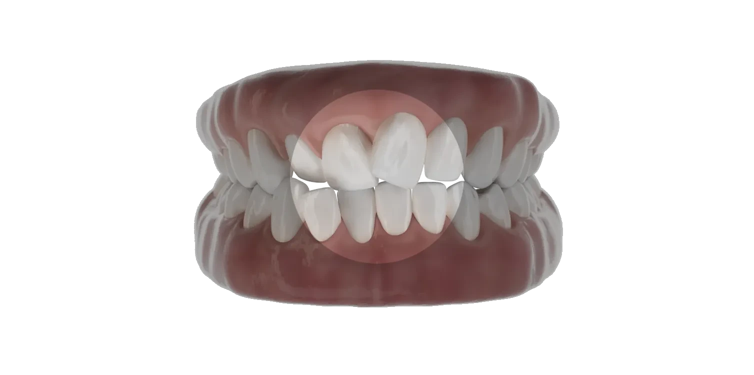 3D-modell som viser trangstilte tenner, med det berørte området markert