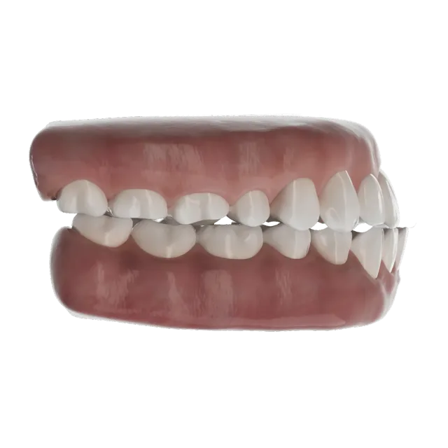 3D-modell av underbitt
