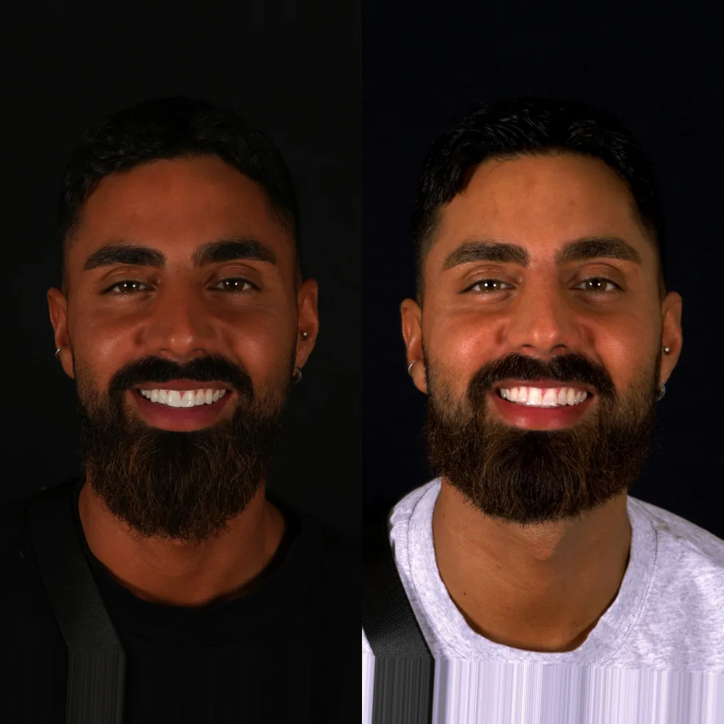 Før og etter edge bonding av tannkantene hos Smile Nordic