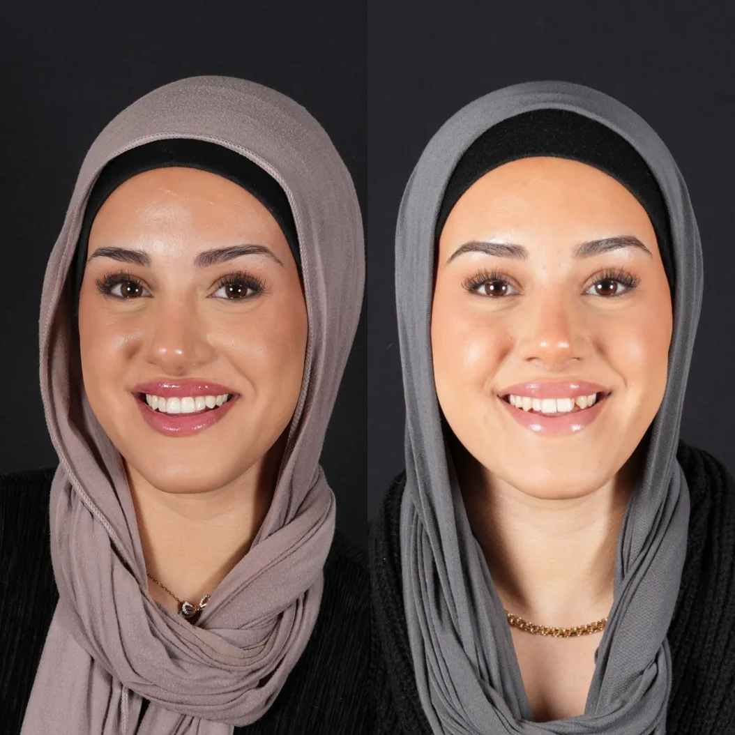 Før og etter behandling av trangstilling hos Smile Nordic