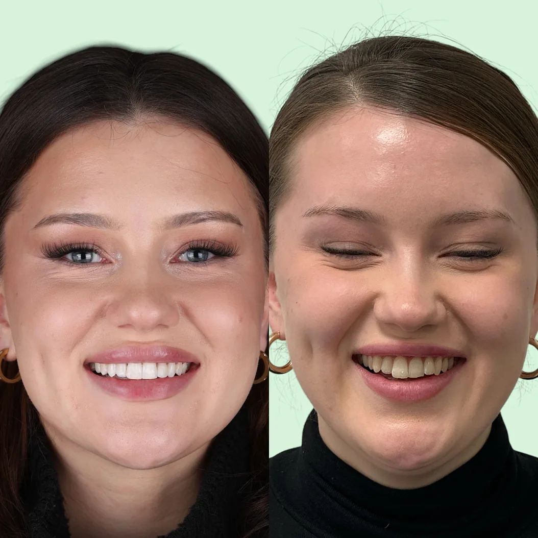 Før og etter utjevning av ulik tannlengde hos Smile Nordic